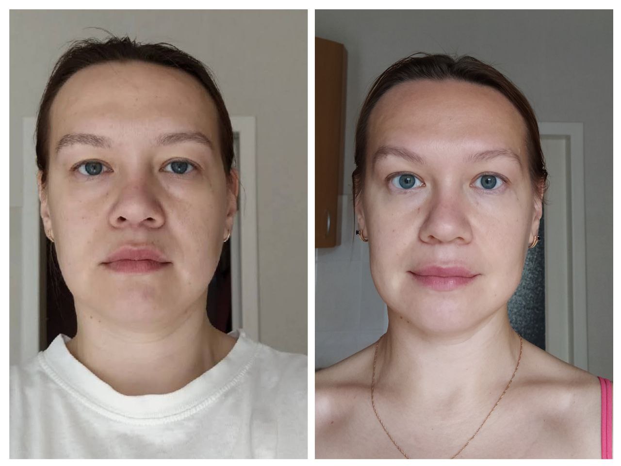 До и после FitLine акне кожа лица