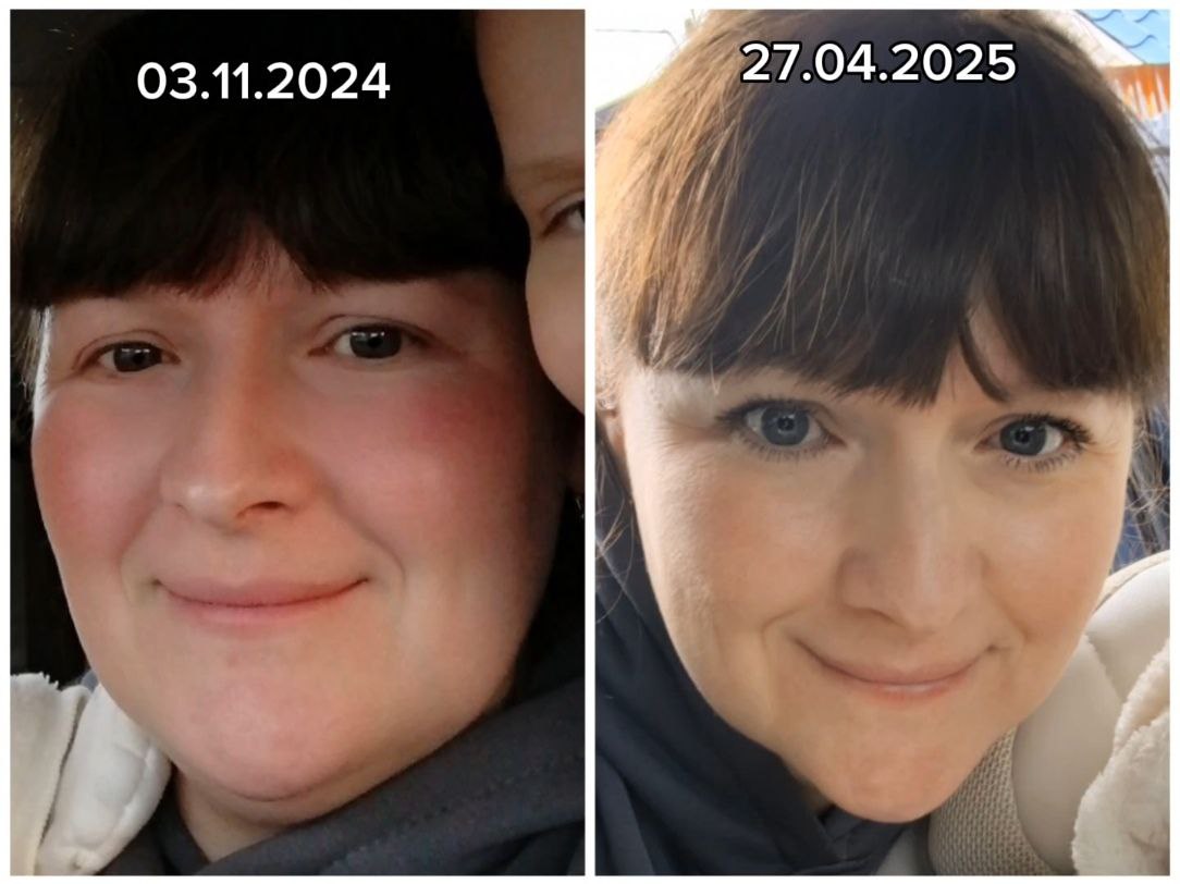 До и после FitLine кожа покраснения ноябрь апрель 2025
