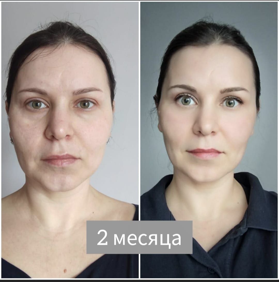До и после FitLine кожа лица 2 месяца
